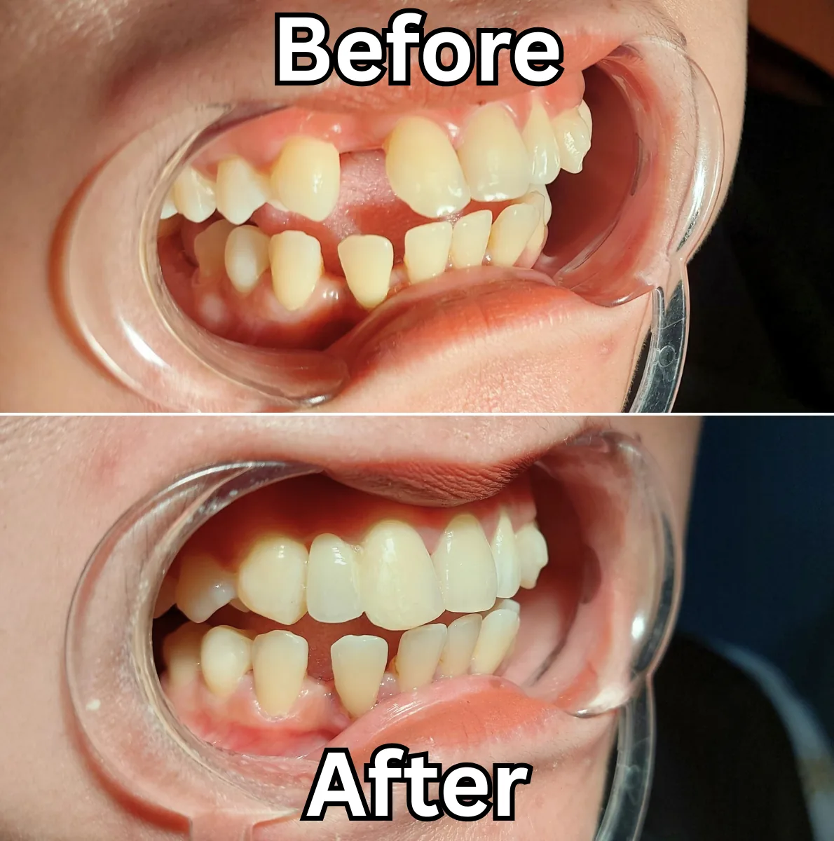 Contoh dokumentasi before-after perawatan gigi palsu