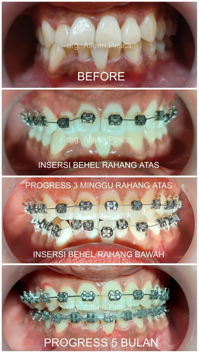Contoh dokumentasi progress perawatan behel