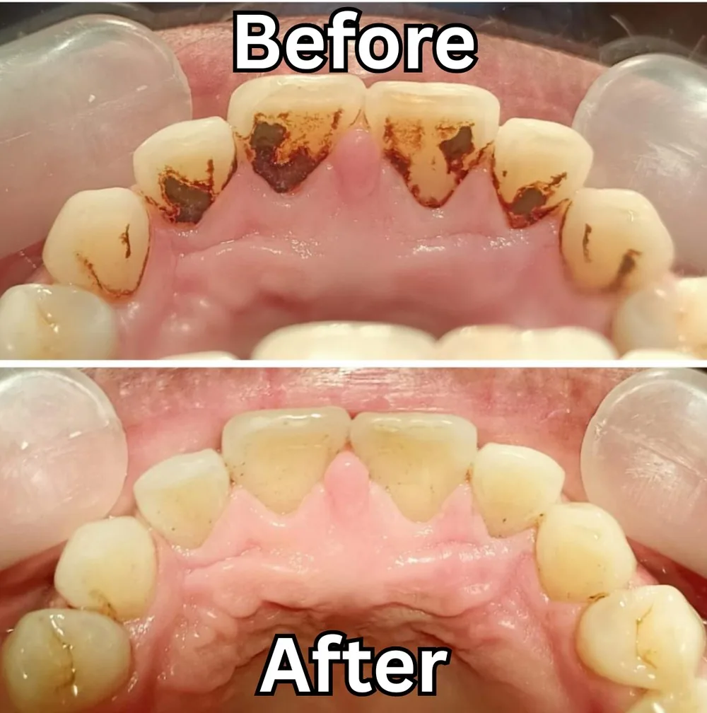 Contoh dokumentasi before-after scaling karang gigi
